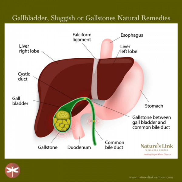 Sluggish Gallbladder or Gallstones?